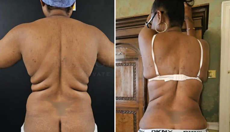 back vaser liposuction before and after-7