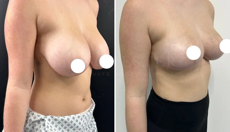 breast reduction before and after 10 week results-1