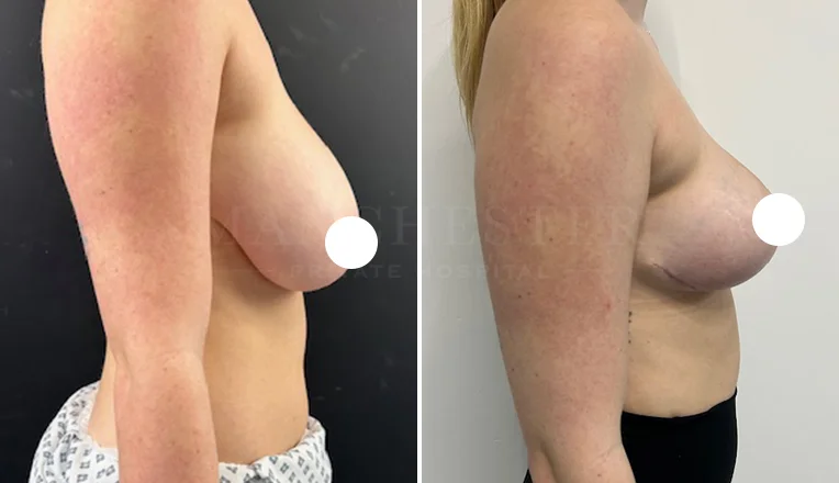 breast reduction before and after 10 week results-2