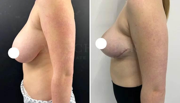 breast reduction before and after 10 week results-4