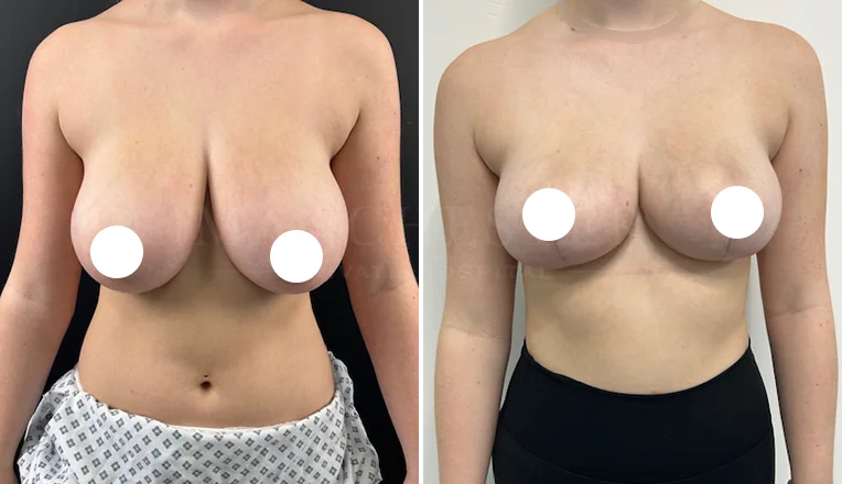 breast reduction before and after 10 week results