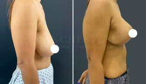 breast uplift before and after-5-v1