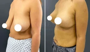 breast uplift before and after-5-v3