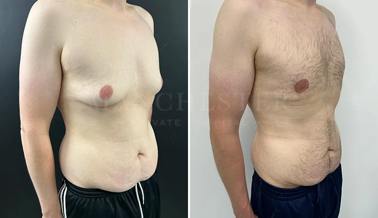 gynecomastia liposuction before and after patient-8-v1