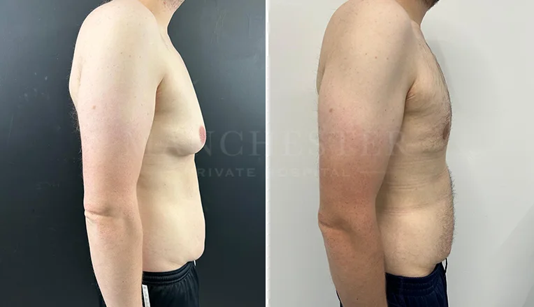 gynecomastia liposuction before and after patient-8-v2