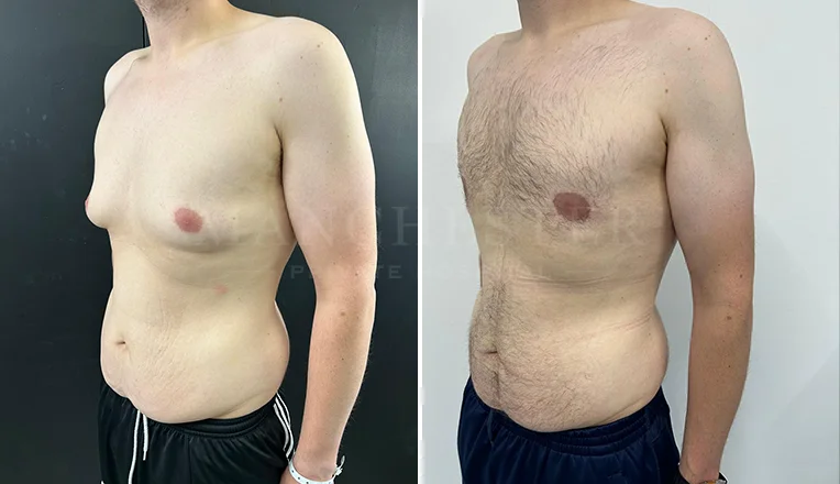 gynecomastia liposuction before and after patient-8-v3