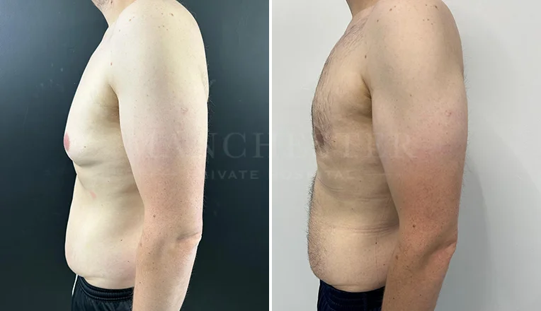 gynecomastia liposuction before and after patient-8-v4