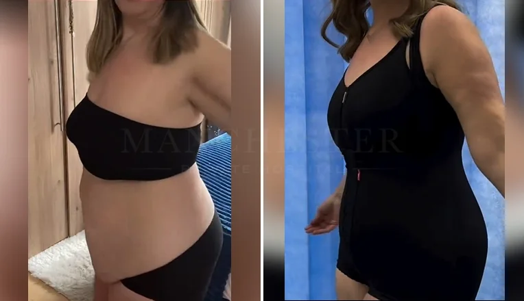 mummy makeover with tummy tuck vaser lipo and breast augmentation-1-v1