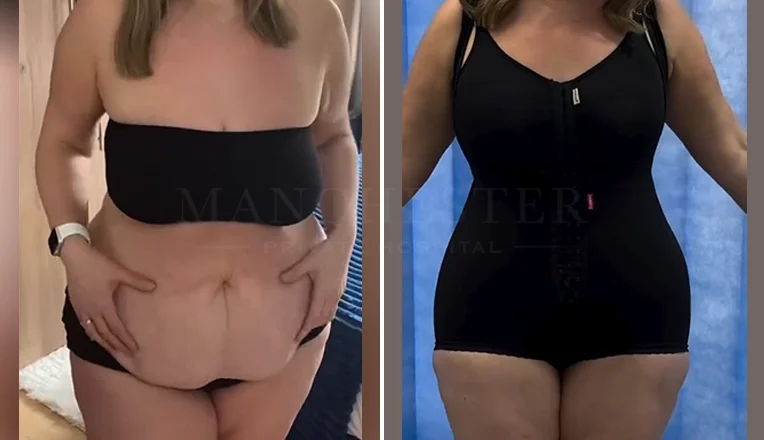 mummy makeover with tummy tuck vaser lipo and breast augmentation-1