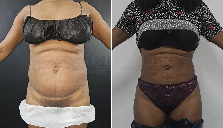 stomach vaser lipo before and after-10