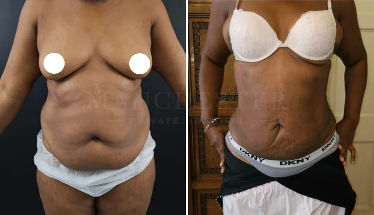 stomach vaser liposuction before and after-11-v1