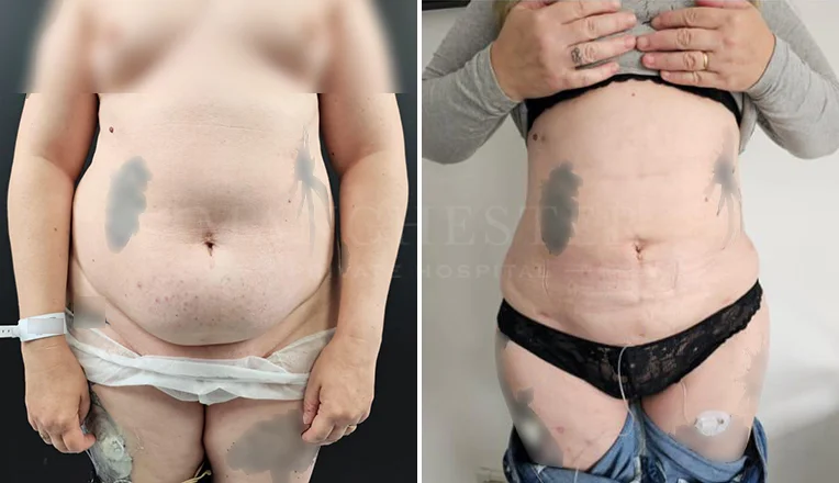 stomach vaser liposuction before and after-13