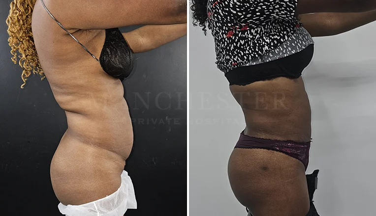 vaser lipo female abs before and after-10-v1