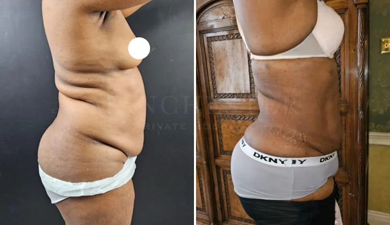 vaser lipo female abs before and after-11