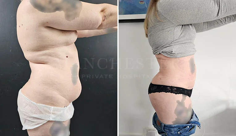 vaser lipo female abs before and after-13