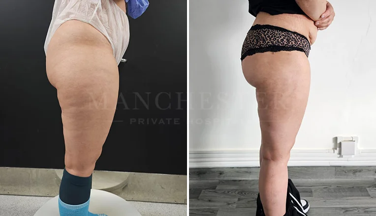 vaser liposuction legs before and after patient-7-v2