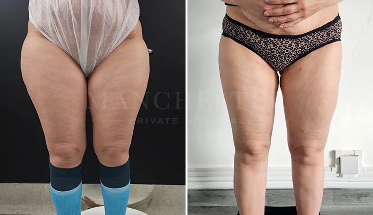 vaser liposuction legs before and after patient-7