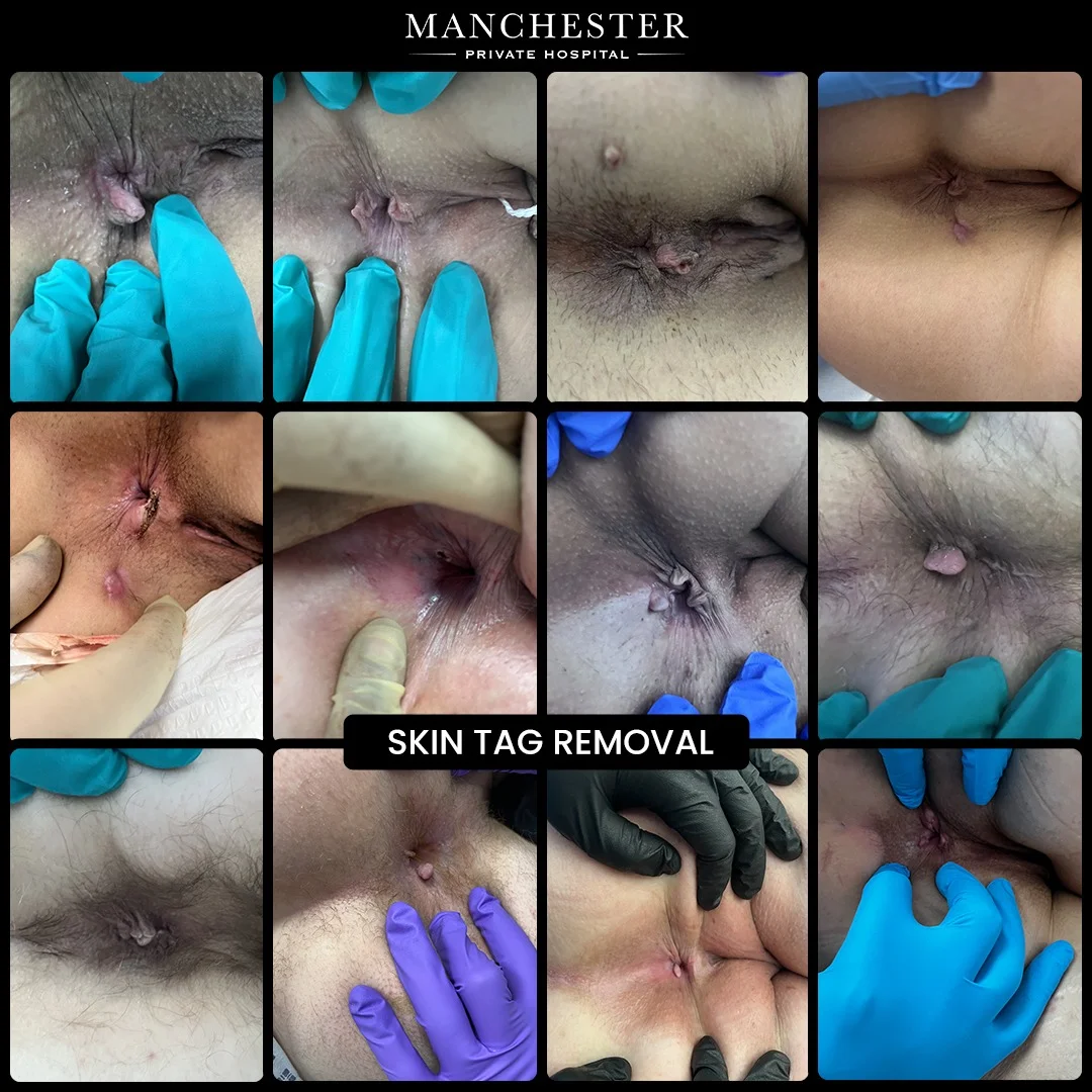 anal skin tag removal mph patients