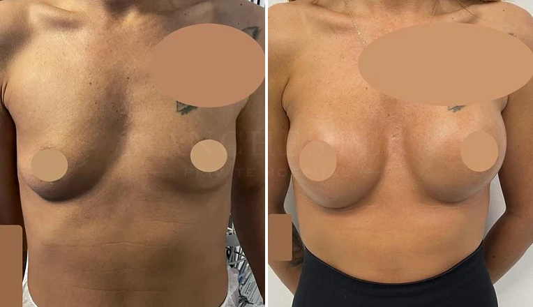 breast augmentation before and after-2