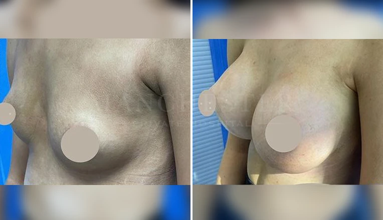 breast augmentation before and after-3-v2