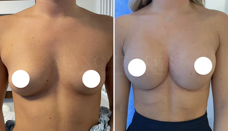 breast augmentation before and after-5