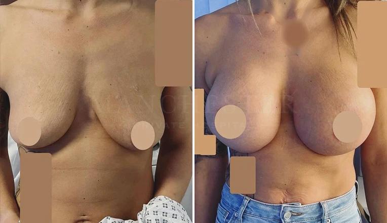 breast augmentation before and after-6