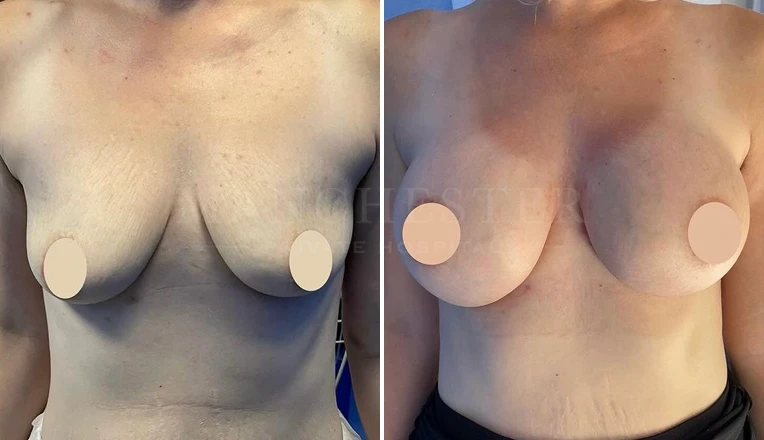 breast enlargement before and after-3