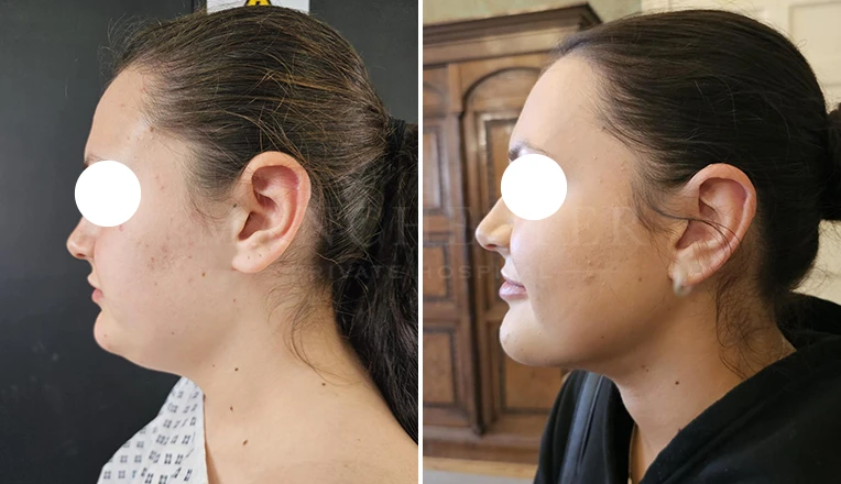 chin vaser liposuction before and after-3-v1