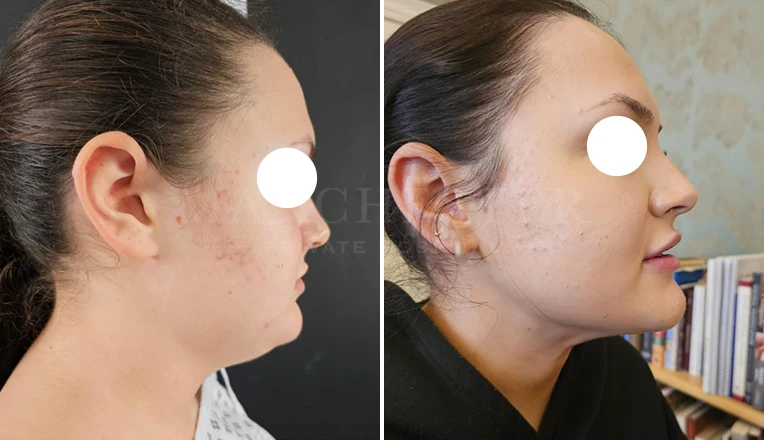 chin vaser liposuction before and after-3-v2