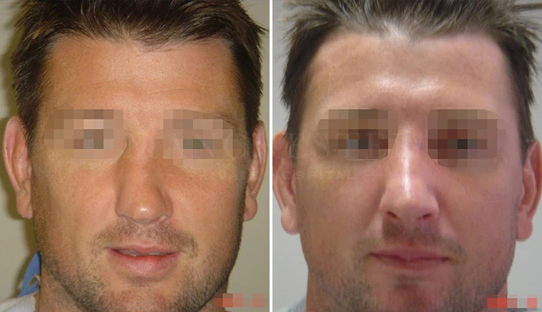 male rhinoplasty before after