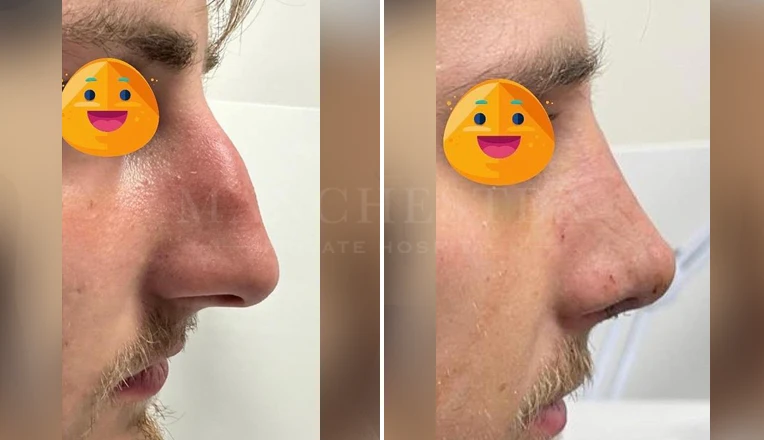 men nose job before and after result-1-v1