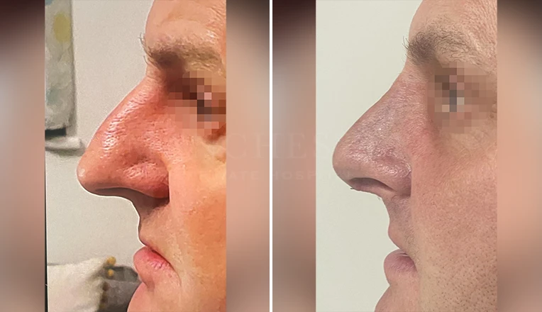 rhinoplasty before and after male patient