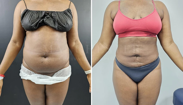 stomach vaser liposuction before and after-14