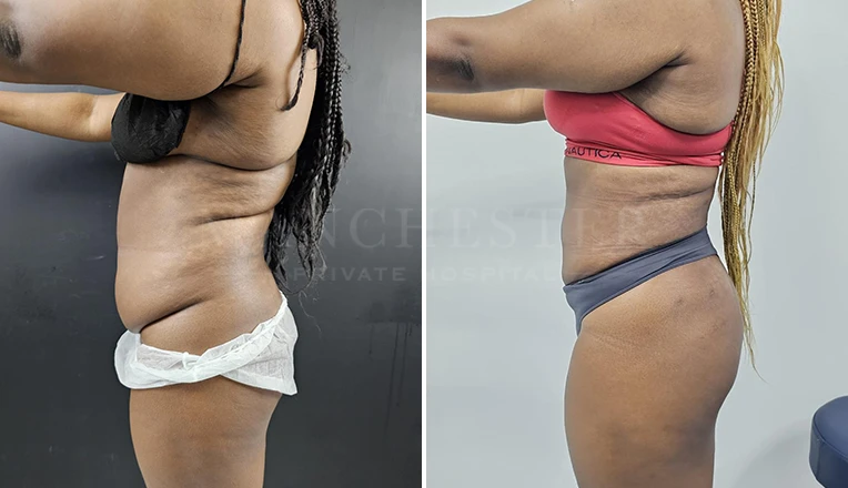 vaser lipo female abs before and after-14-v1