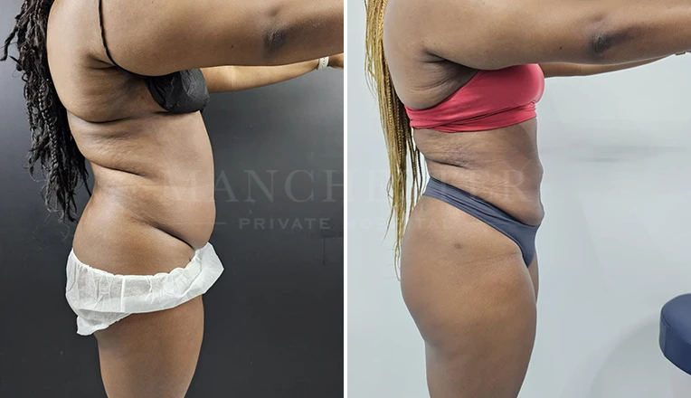 vaser lipo female abs before and after-14