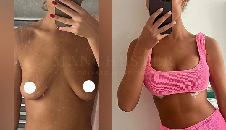 breast lift with implants patient result