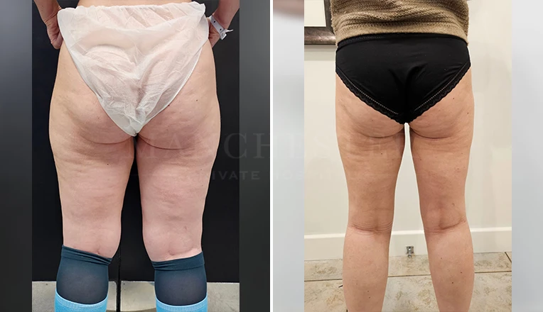 thigh vaser liposuction before and after