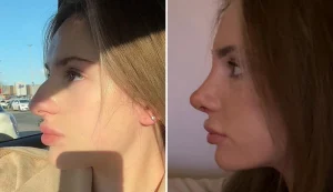 rhinoplasty before and after patient-14