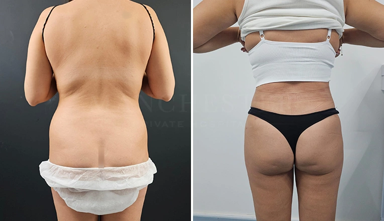 back vaser liposuction before and after result-13