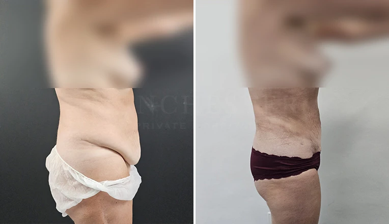 stomach vaser lipo before and after result-12-v2