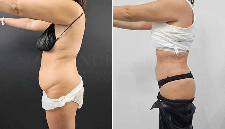 stomach vaser lipo before and after result-13-v1