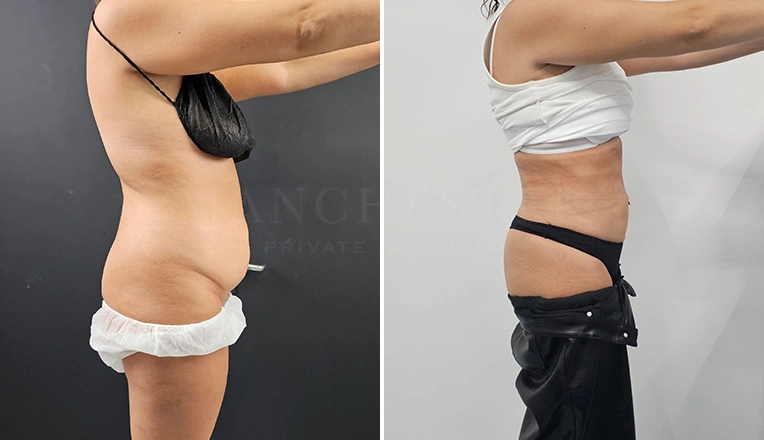 stomach vaser lipo before and after result-13