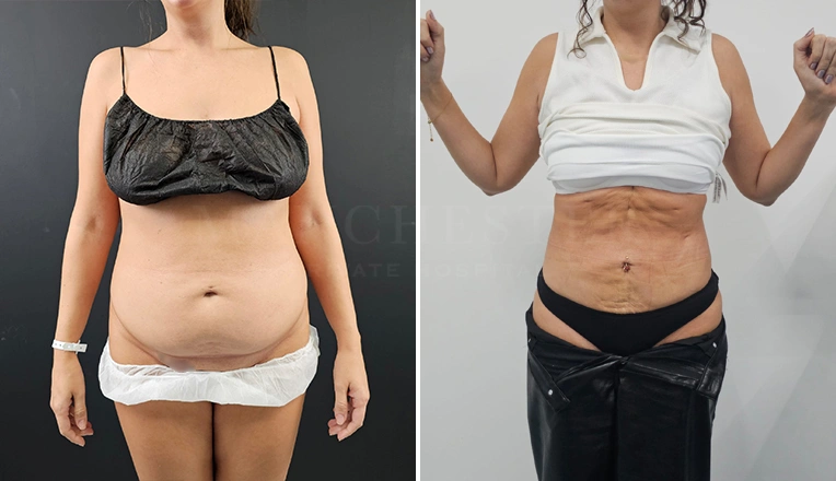 vaser lipo before and after stomach result-13