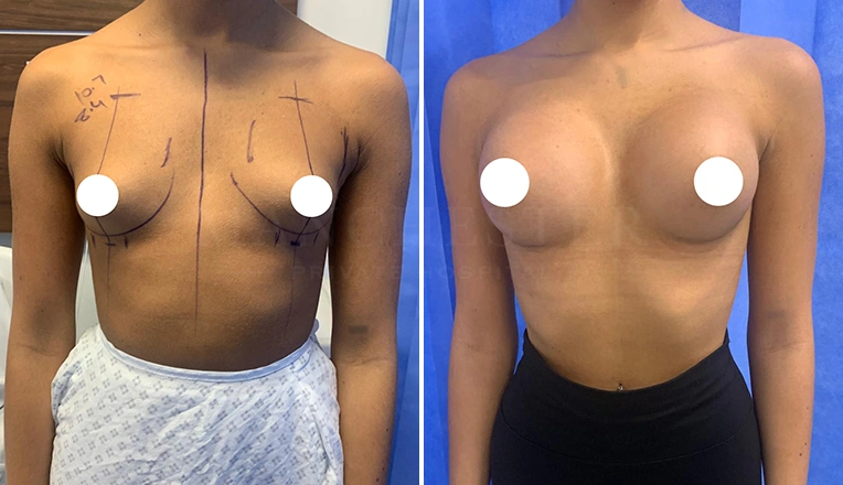 breast enlargement patient result-14