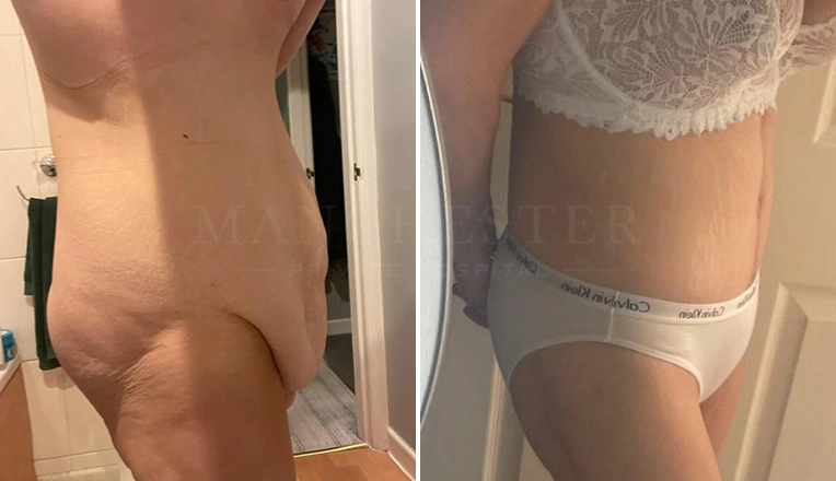 fdl abdominoplasty muscle repair and vaser lipo before and after-1