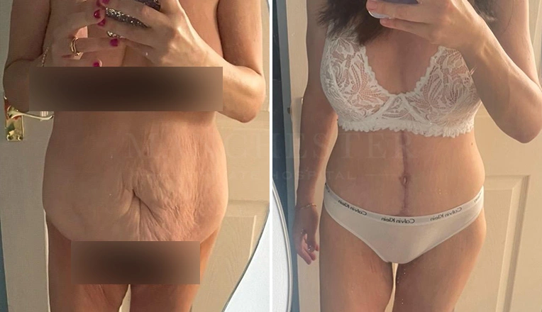 fdl abdominoplasty muscle repair and vaser lipo before and after