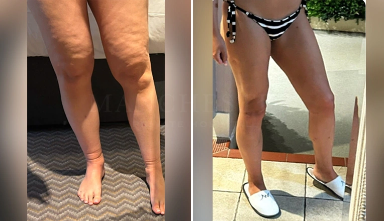 lipedema liposuction before and after patient-7