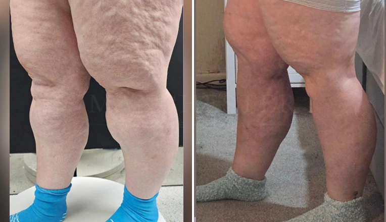 lover leg lipoedema liposuction