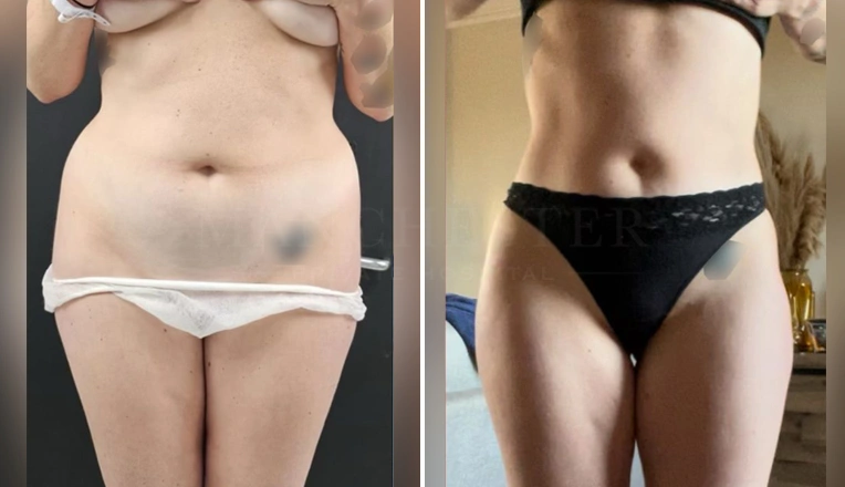 vaser lipo abdomen flanks before and after