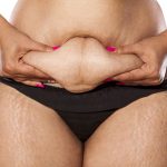 What Is an Apron Belly? Understanding the Causes and Effects of a Belly Apron